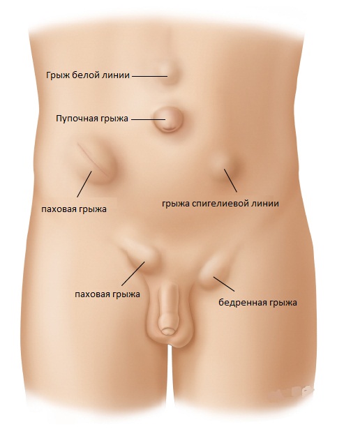грыжи 1.jpg